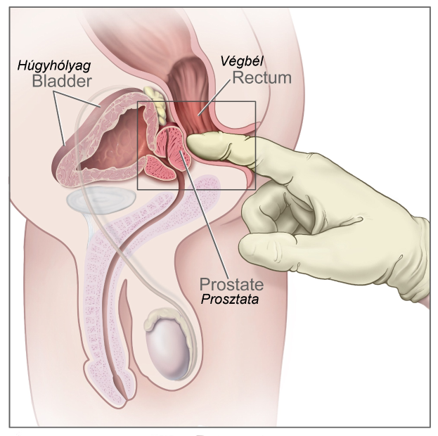 Diagramm des männlichen Fortpflanzungssystems, das die Prostata hervorhebt, mit dem Text "Prostata-Prostata-Operation" und einer animierten Ansicht der Anatomie.