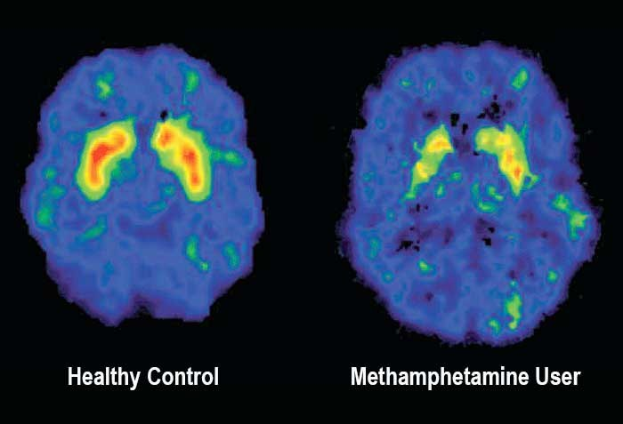 Zwei MRI-Hirn-Scans nebeneinander, wobei das linke mit "gesunder Kontroll" und das rechte mit "Methamphetamin-Nutzer" beschriftet ist, vor einem dunklen Hintergrund.