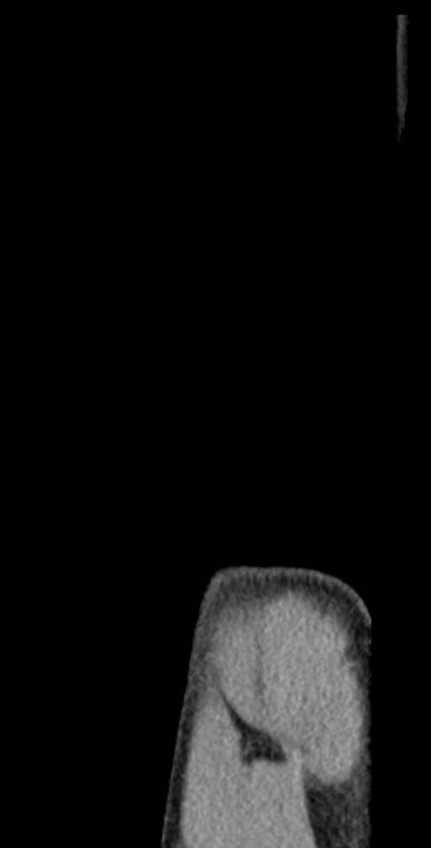 Schwarze und weiße MRI-Aufnahme, die detaillierte Anatomie eines Patientenknies zeigt.